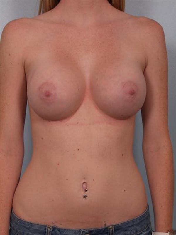 Breast Augmentation Before & After Gallery - Patient 1310401 - Image 2