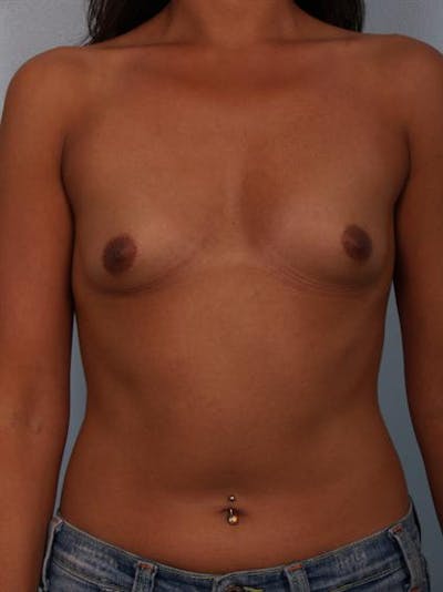 Breast Augmentation Before & After Gallery - Patient 1310403 - Image 1