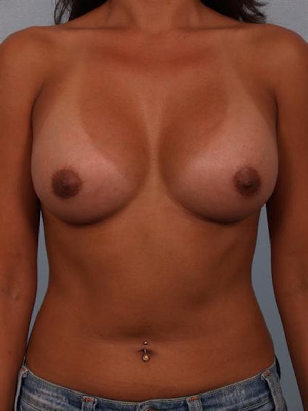 Breast Augmentation Before & After Gallery - Patient 1310403 - Image 2