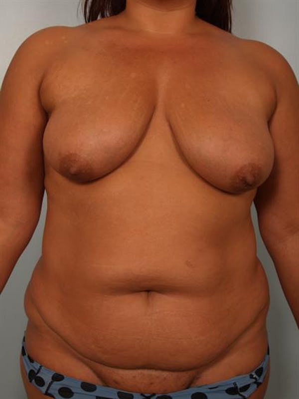 Breast Lift Before & After Gallery - Patient 1310404 - Image 1