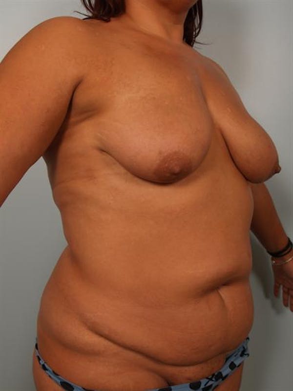 Breast Lift Before & After Gallery - Patient 1310404 - Image 3