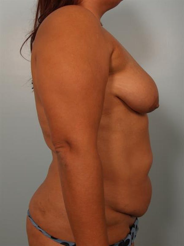 Breast Lift Before & After Gallery - Patient 1310404 - Image 5