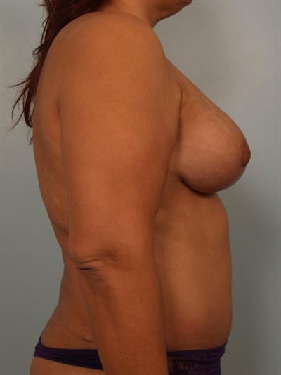 Breast Lift Before & After Gallery - Patient 1310404 - Image 6