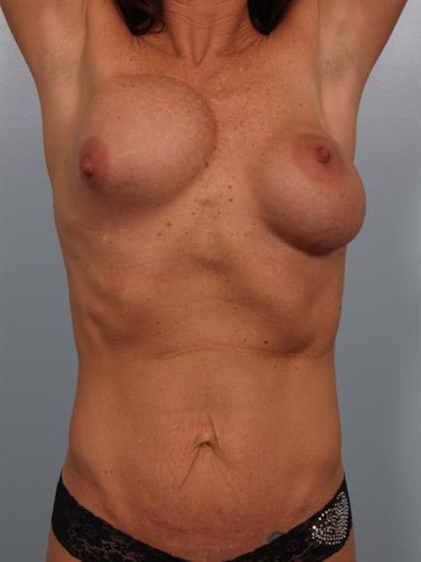 Breast Lift Before & After Gallery - Patient 1310410 - Image 3