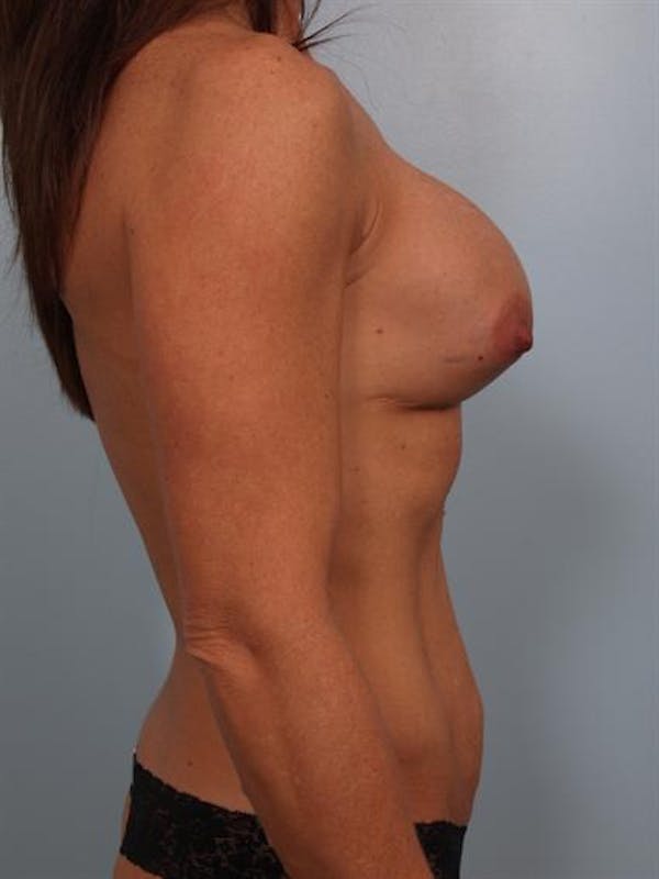 Breast Lift Before & After Gallery - Patient 1310410 - Image 5