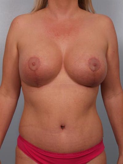 Breast Augmentation Before & After Gallery - Patient 1310408 - Image 4