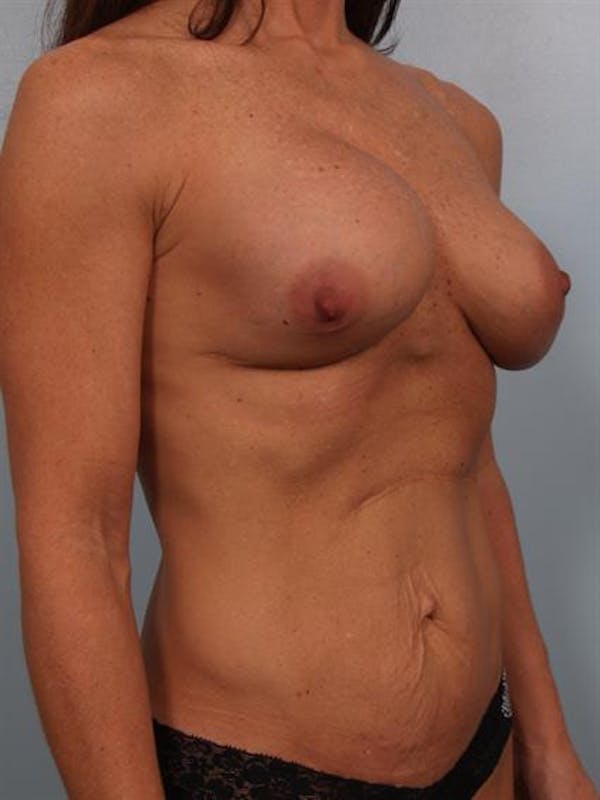 Breast Lift Before & After Gallery - Patient 1310410 - Image 7