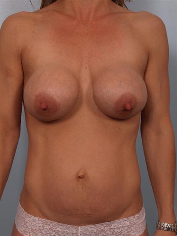 Breast Lift Gallery - Patient 1310413 - Image 1