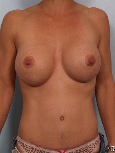 Breast Lift Gallery - Patient 1310413 - Image 2