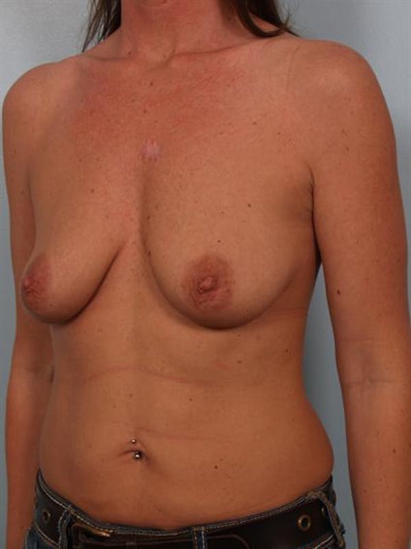 Breast Augmentation Before & After Gallery - Patient 1310414 - Image 3