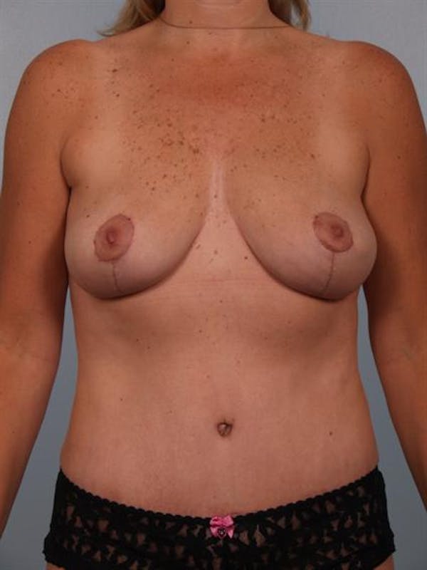 Breast Lift Before & After Gallery - Patient 1310415 - Image 2