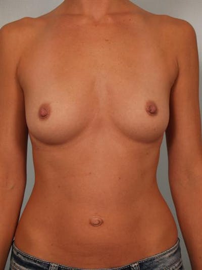 Breast Augmentation Before & After Gallery - Patient 1310416 - Image 1