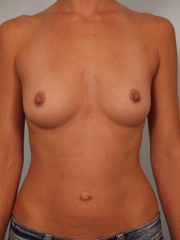 Breast Augmentation Gallery - Patient 1310416 - Image 1