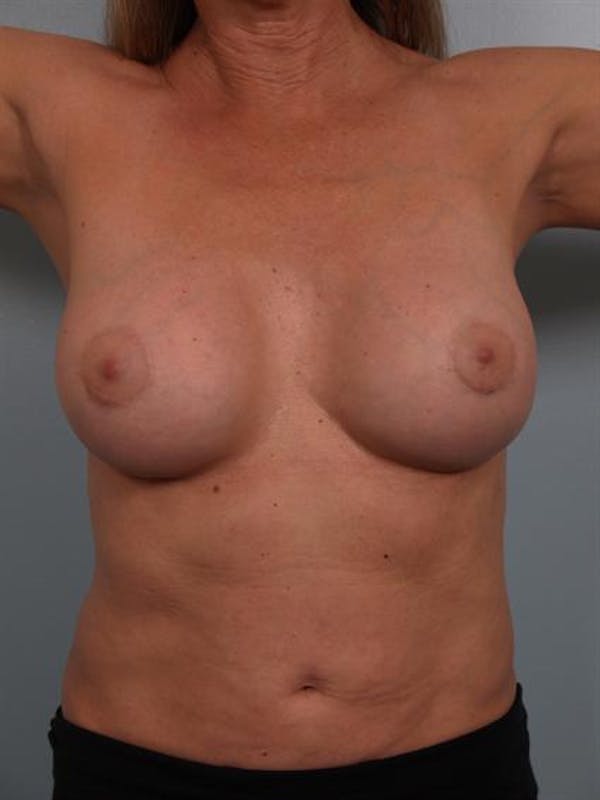 Breast Lift Before & After Gallery - Patient 1310417 - Image 2