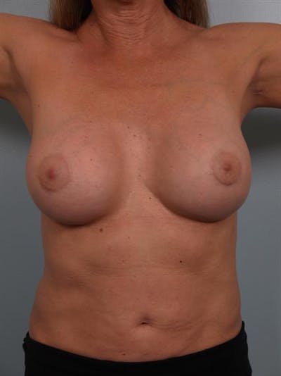 Breast Lift Before & After Gallery - Patient 1310417 - Image 2