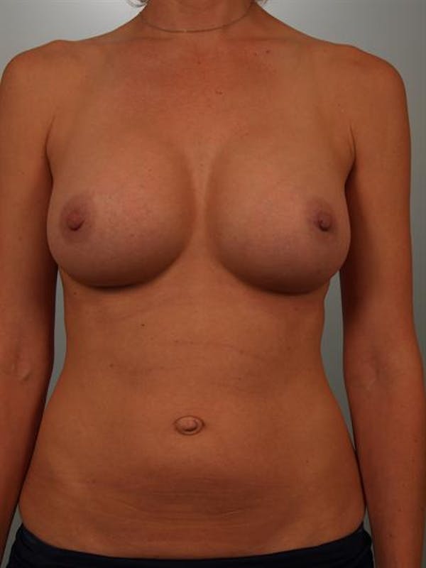 Breast Augmentation Before & After Gallery - Patient 1310416 - Image 2