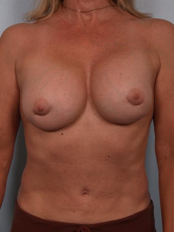 Breast Lift Before & After Gallery - Patient 1310417 - Image 3