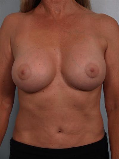 Breast Lift Before & After Gallery - Patient 1310417 - Image 4