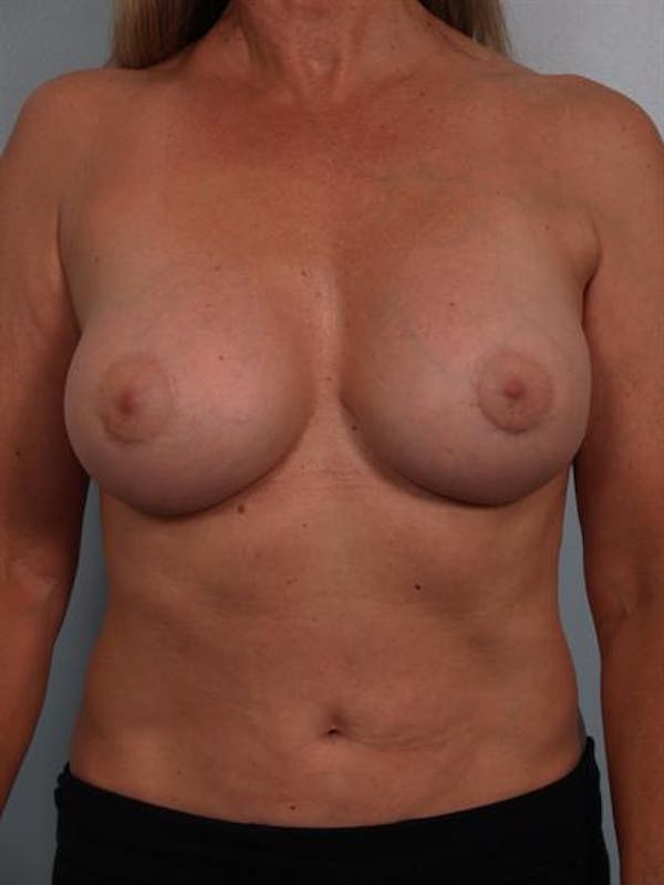 Breast Lift Before & After Gallery - Patient 1310417 - Image 4