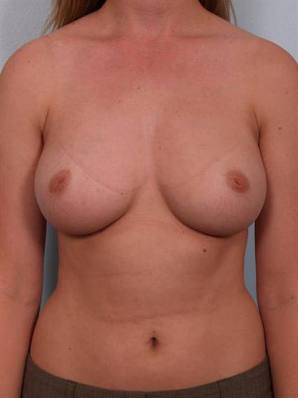 Nipple/Areolar Surgery Before & After Gallery - Patient 1310418 - Image 3