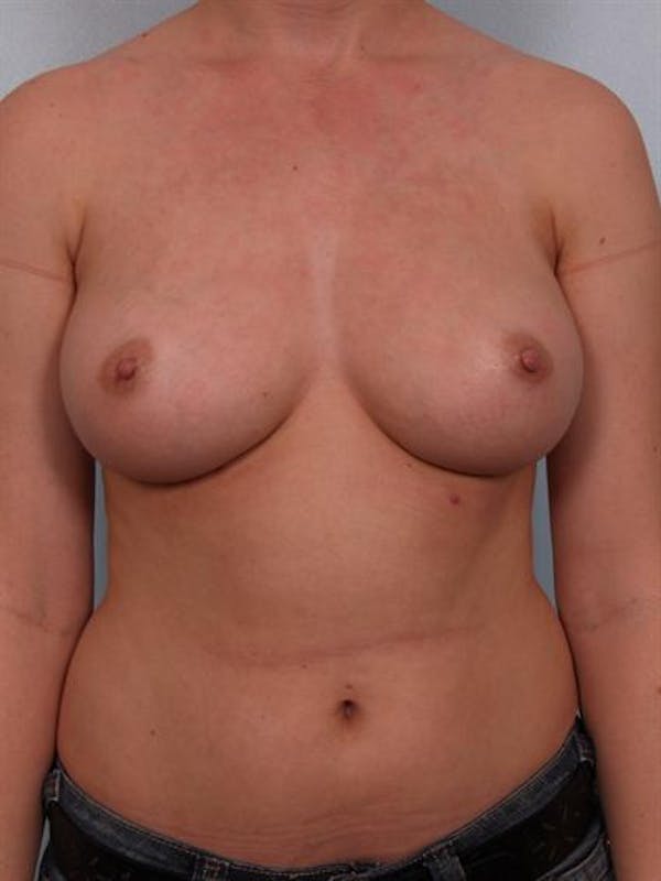 Nipple/Areolar Surgery Before & After Gallery - Patient 1310418 - Image 4