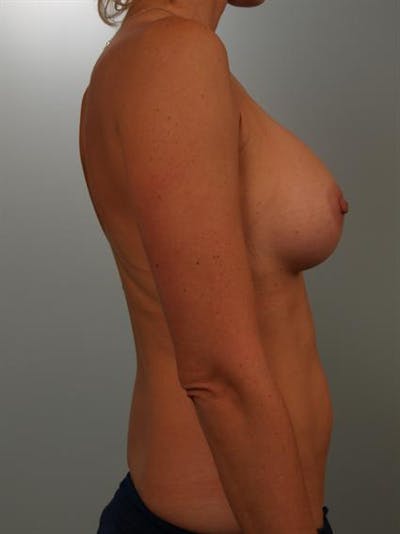 Breast Augmentation Before & After Gallery - Patient 1310416 - Image 6