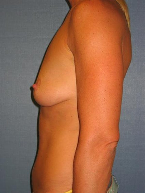 Breast Lift Gallery - Patient 1310419 - Image 3