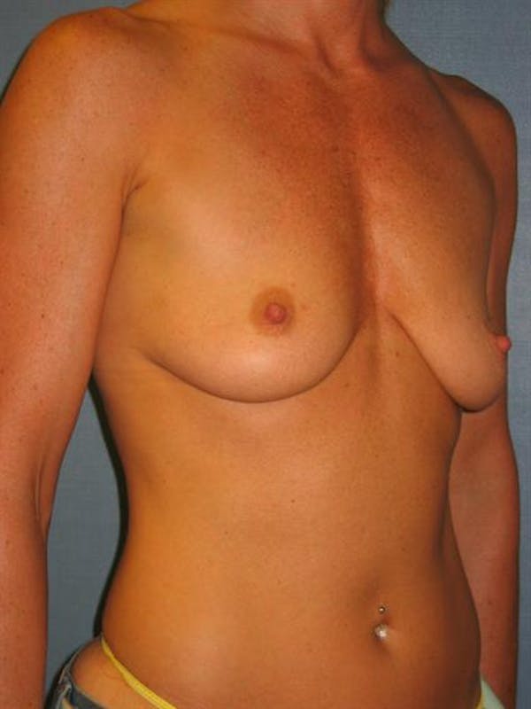 Breast Lift Before & After Gallery - Patient 1310419 - Image 5