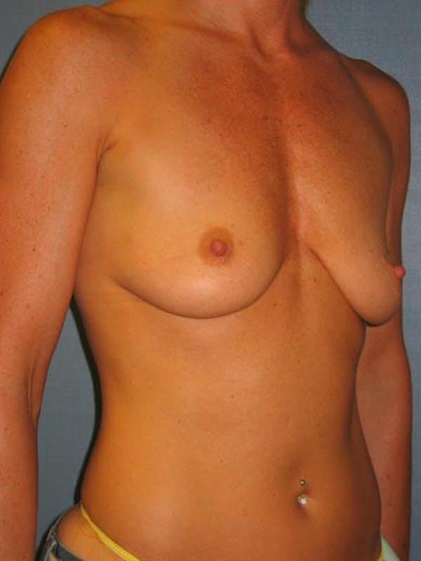 Breast Lift Gallery - Patient 1310419 - Image 5