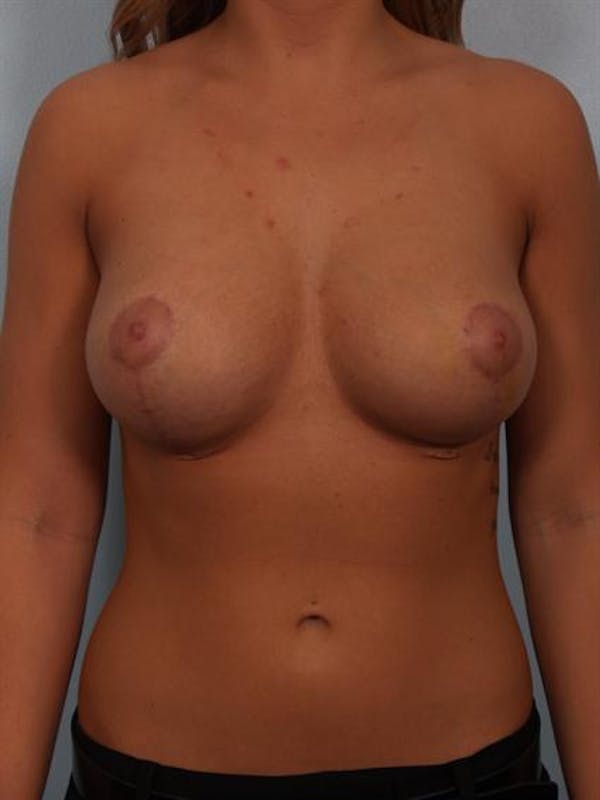 Breast Lift Before & After Gallery - Patient 1310424 - Image 2