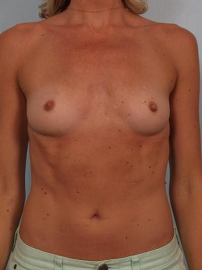 Breast Augmentation Before & After Gallery - Patient 1310426 - Image 1