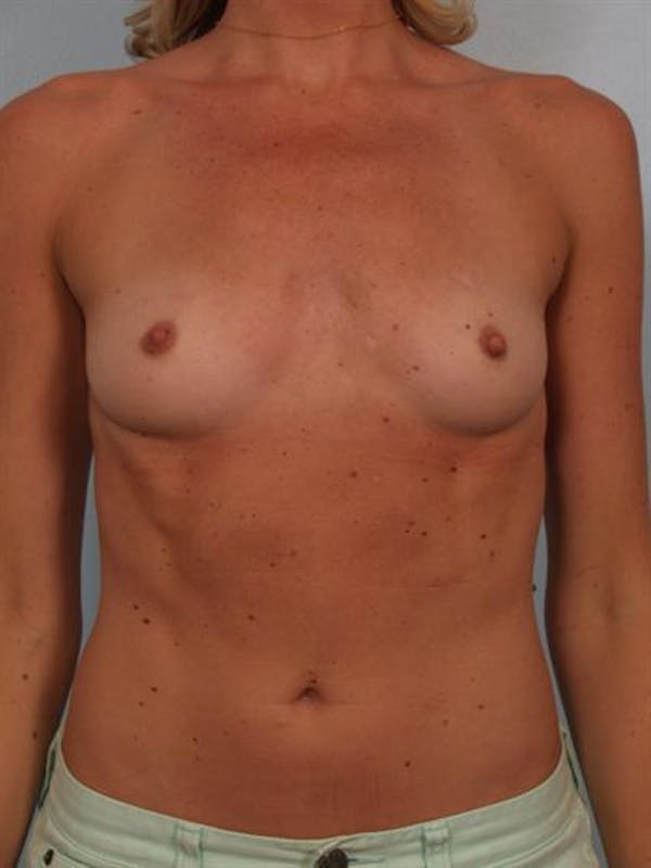 Breast Augmentation Gallery - Patient 1310426 - Image 1