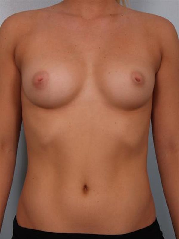 Nipple/Areolar Surgery Before & After Gallery - Patient 1310425 - Image 3