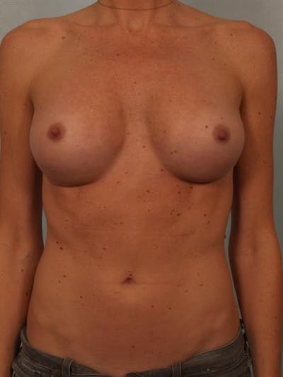Breast Augmentation Before & After Gallery - Patient 1310426 - Image 2