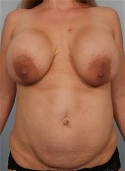 Breast Lift Before & After Gallery - Patient 1310427 - Image 1