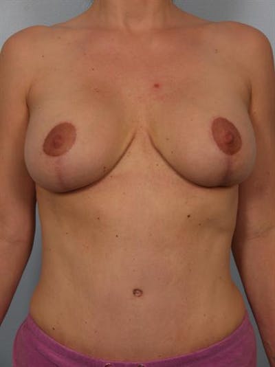 Breast Lift Before & After Gallery - Patient 1310427 - Image 2