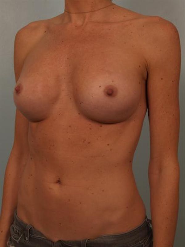 Breast Augmentation Before & After Gallery - Patient 1310426 - Image 6