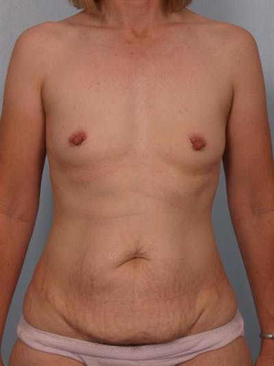 Nipple/Areolar Surgery Before & After Gallery - Patient 1310428 - Image 1