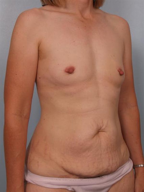 Nipple/Areolar Surgery Before & After Gallery - Patient 1310428 - Image 3