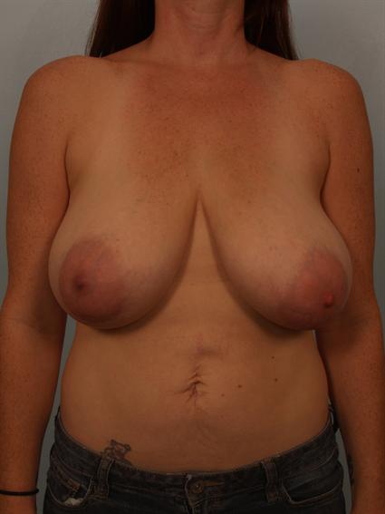 Before image of Breast Reduction in Beverly Hills by Dr. Cohen.