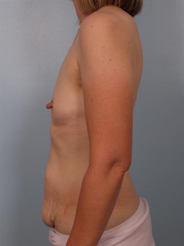 Nipple/Areolar Surgery Before & After Gallery - Patient 1310428 - Image 5