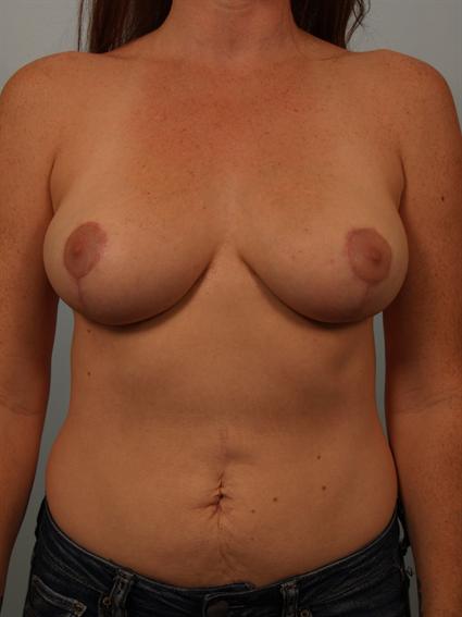 after image of Breast Reduction in Beverly Hills by Dr. Cohen.