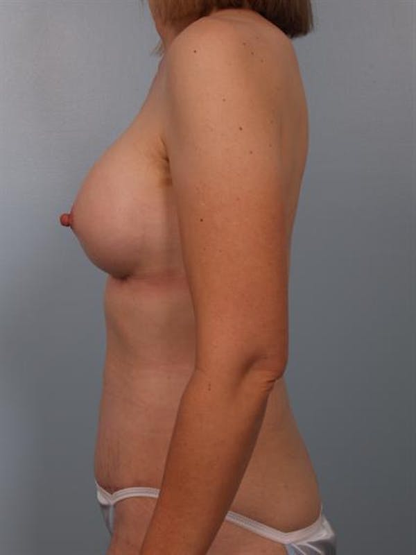 Nipple/Areolar Surgery Before & After Gallery - Patient 1310428 - Image 6