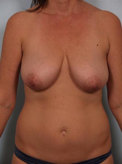 Breast Lift Before & After Gallery - Patient 1310431 - Image 1