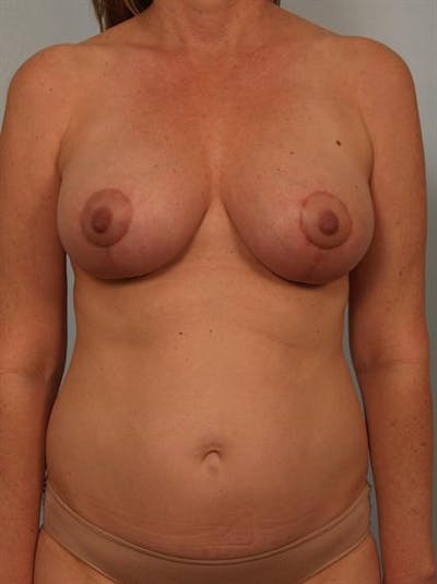 Breast Lift Before & After Gallery - Patient 1310431 - Image 2