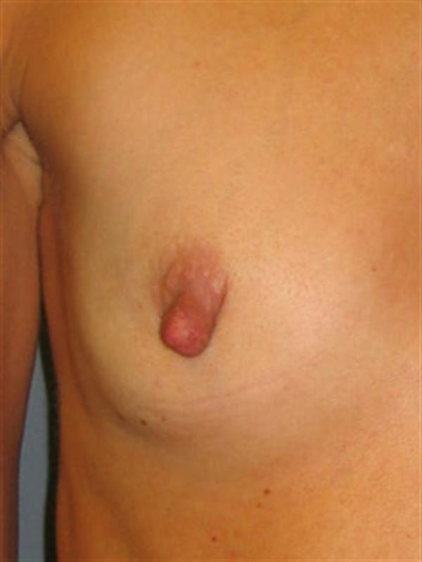 Nipple/Areolar Surgery Before & After Gallery - Patient 1310435 - Image 1