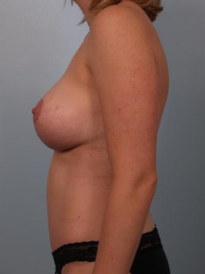 Breast Augmentation Before & After Gallery - Patient 1310430 - Image 6