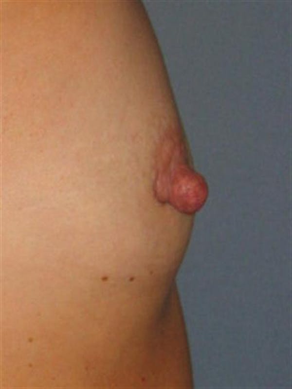 Nipple/Areolar Surgery Before & After Gallery - Patient 1310435 - Image 3