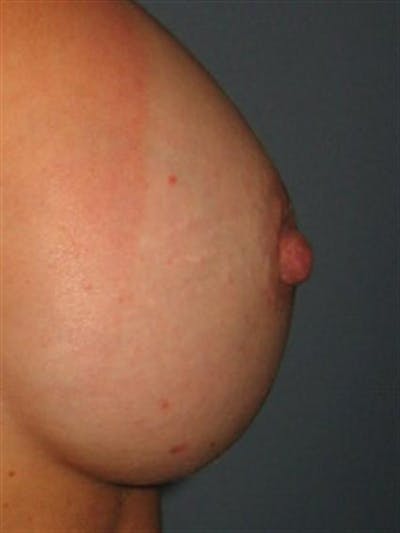 Nipple/Areolar Surgery Before & After Gallery - Patient 1310435 - Image 4
