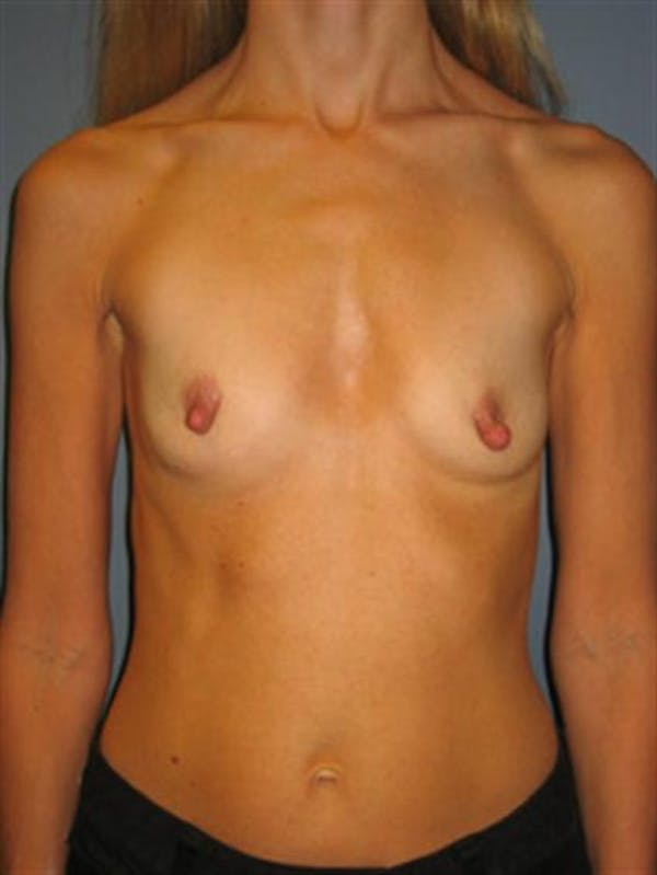 Nipple/Areolar Surgery Before & After Gallery - Patient 1310435 - Image 5